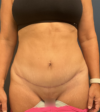 Tummy Tuck case #18685