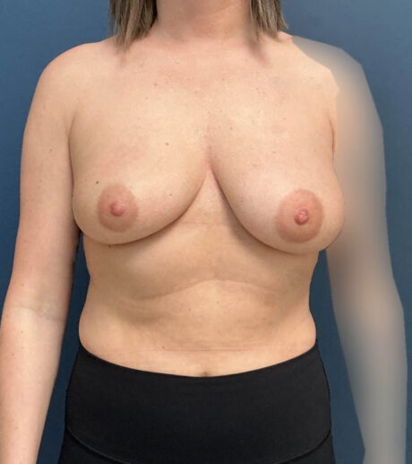 Breast Augmentation With Lift case #19660