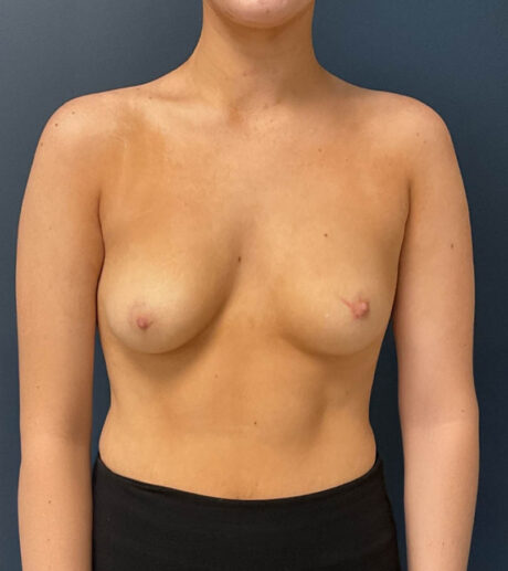Breast Augmentation case #19546