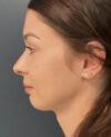 Neck Lift case #19494