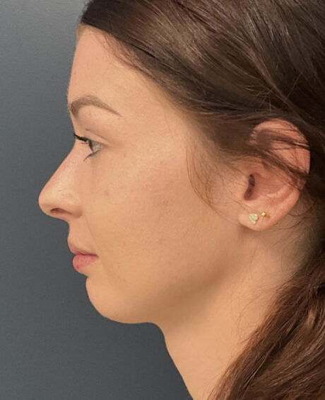 Neck Lift case #19494