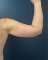 After Weight Loss case #19466