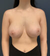 Breast Augmentation case #19546