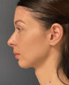 Neck Lift case #19494