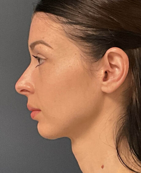Neck Lift case #19494