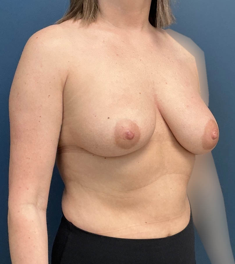 Breast Augmentation With Lift case #19660