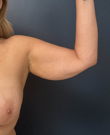 Arm Lift case #19456