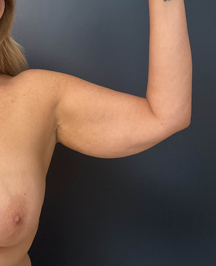 Arm Lift case #19456
