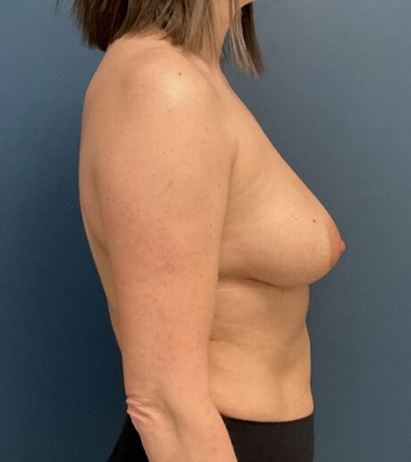 Breast Augmentation With Lift case #19660