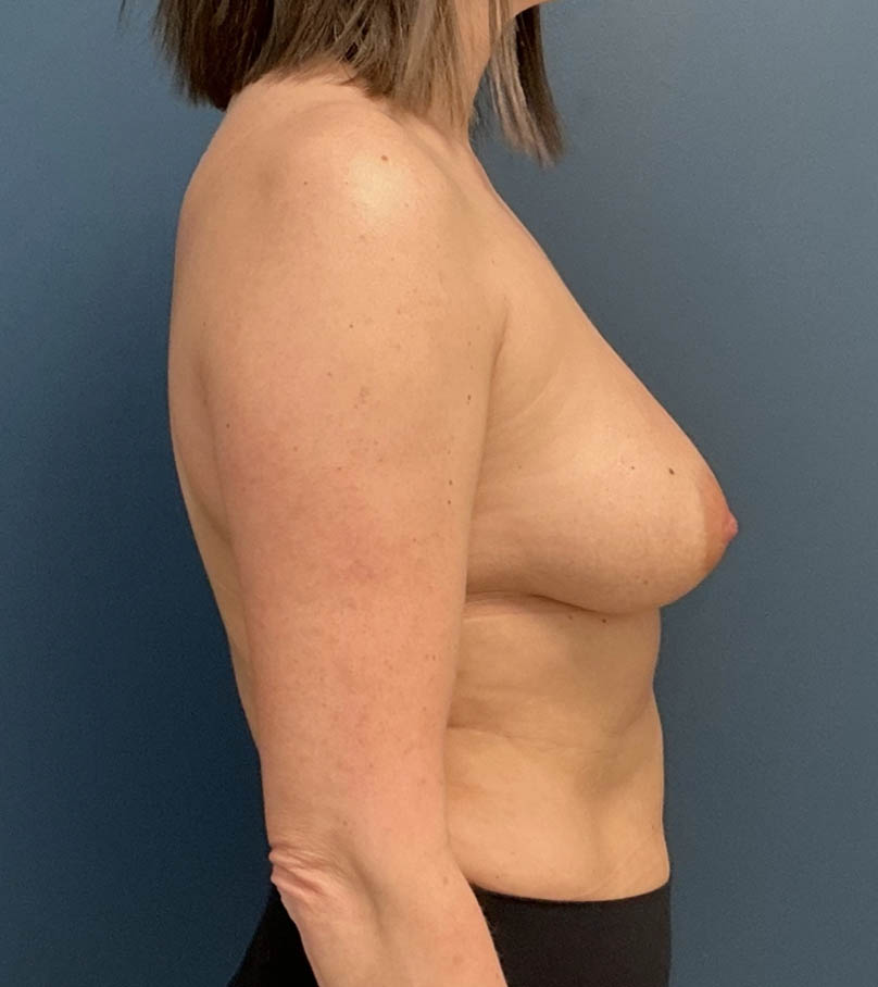 Breast Augmentation With Lift case #19660
