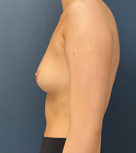 Breast Augmentation case #19546