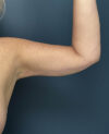 Arm Lift case #19456