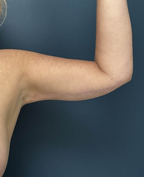 Arm Lift case #19456