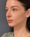 Neck Lift case #19494
