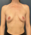 Breast Augmentation case #19668