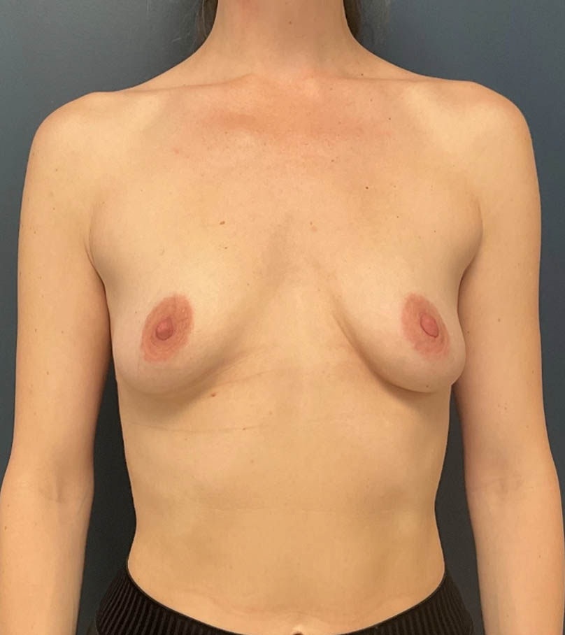 Breast Augmentation case #19668