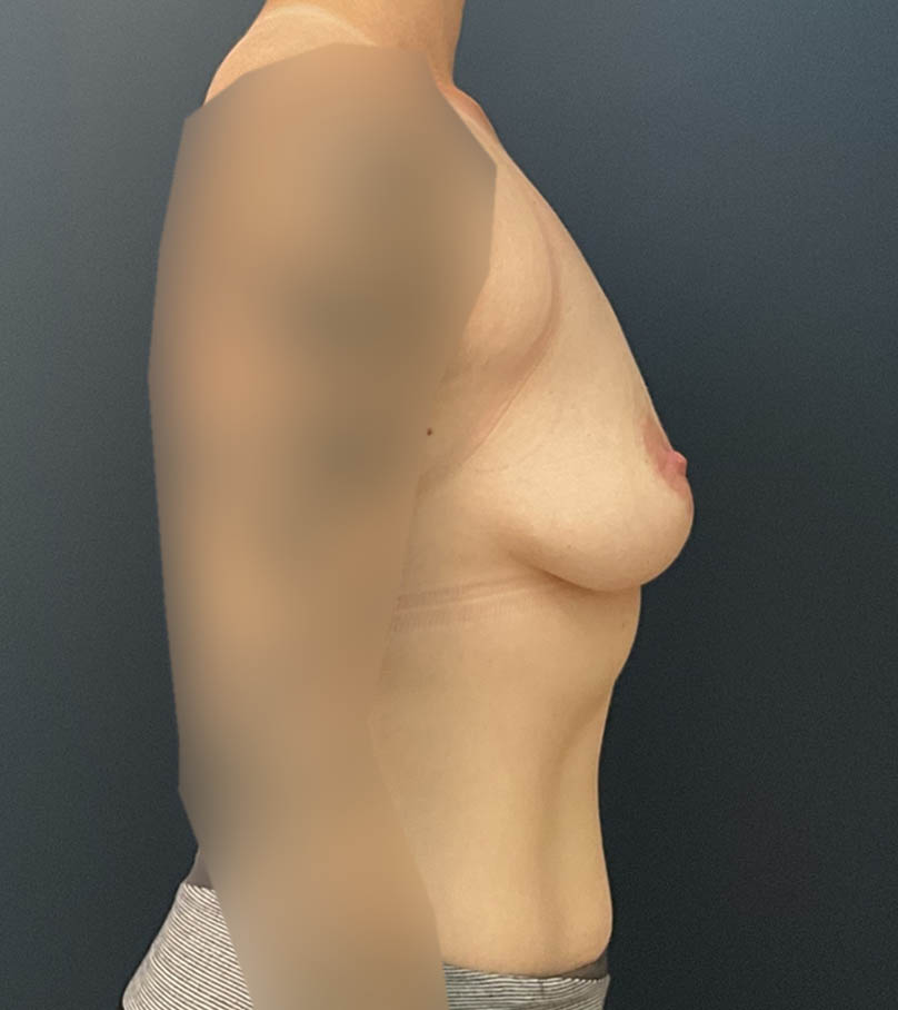 Breast Augmentation case #19554