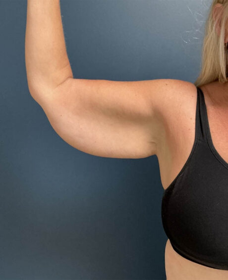 Arm Lift case #19473