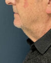 Neck Lift case #19501
