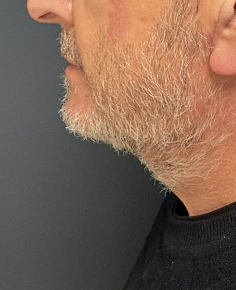 Neck Lift case #19501