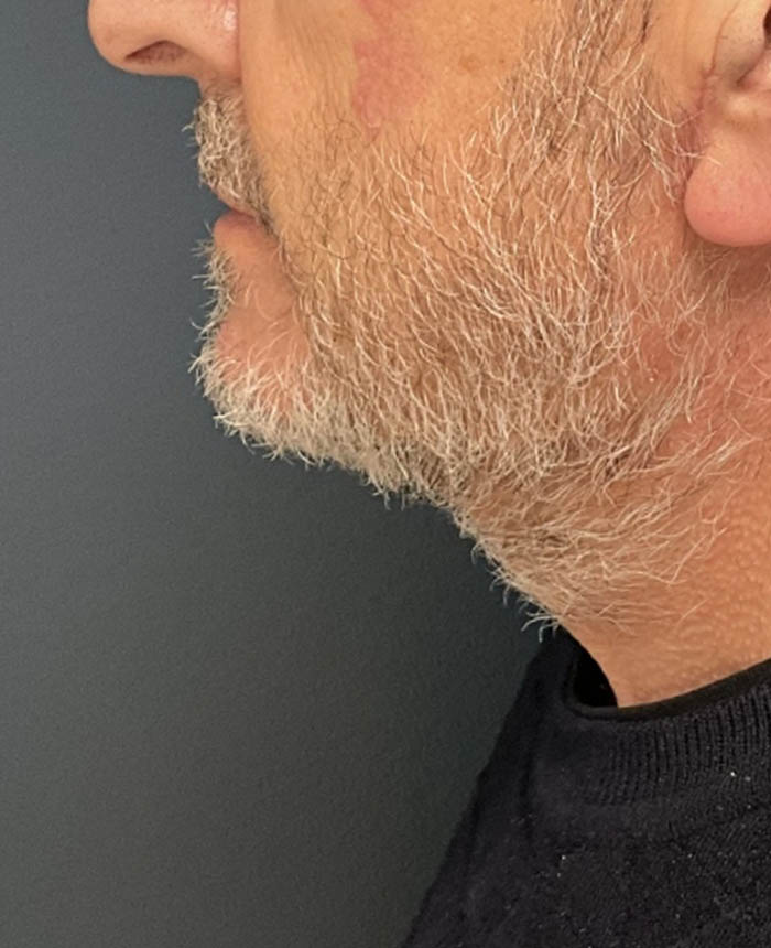 Neck Lift case #19501