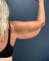 Arm Lift case #19473