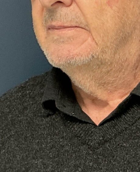 Neck Lift case #19501