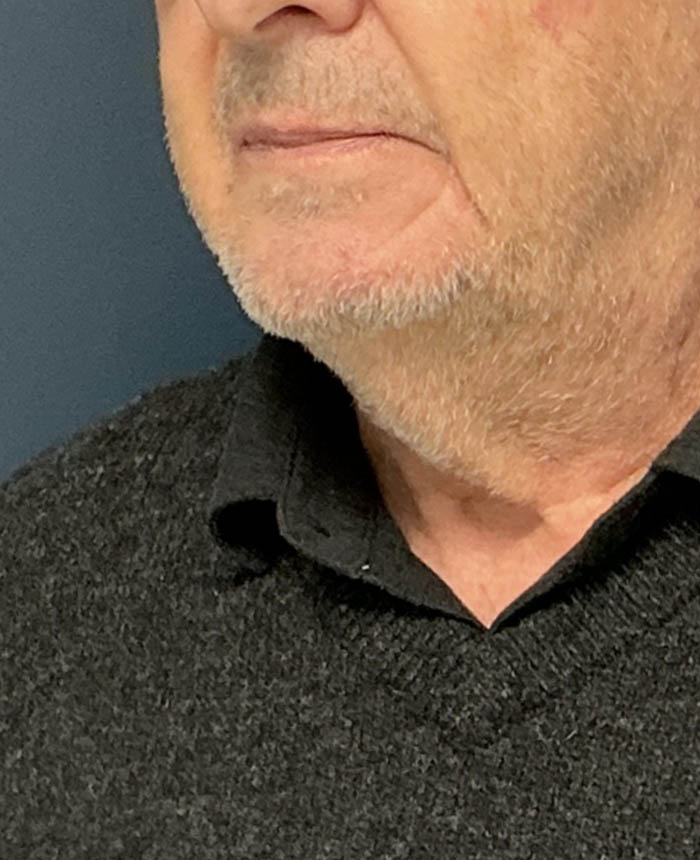 Neck Lift case #19501