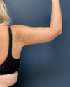Arm Lift case #19473