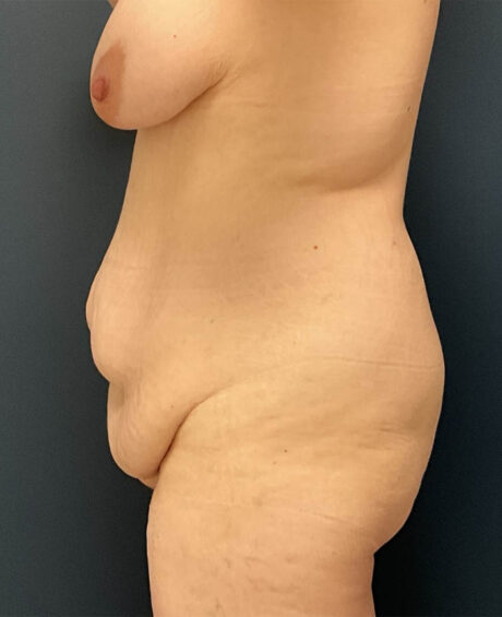 After Weight Loss case #19489