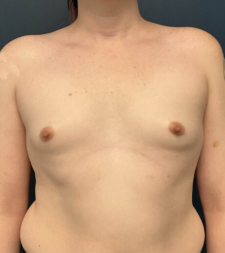 Breast Augmentation case #19568
