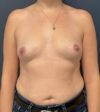 Breast Augmentation case #19682