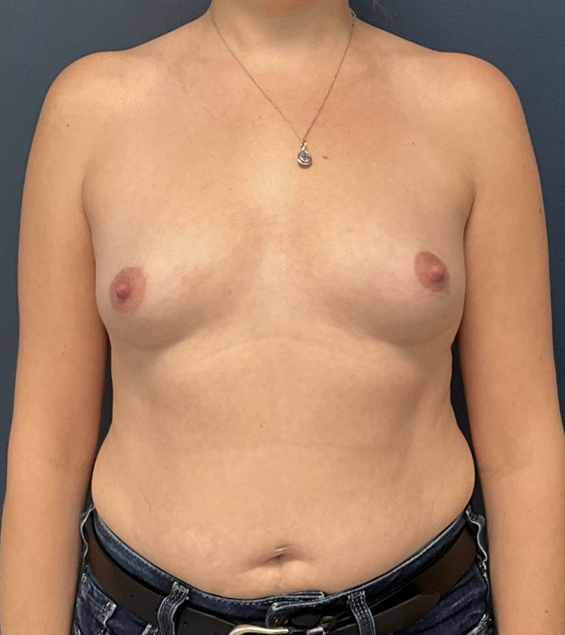 Breast Augmentation case #19682