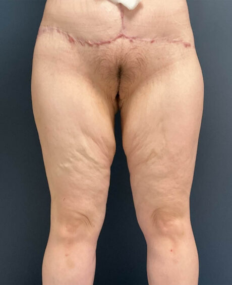 Thigh, Buttock, & Arm Lift case #19478