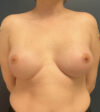 Breast Augmentation case #19568
