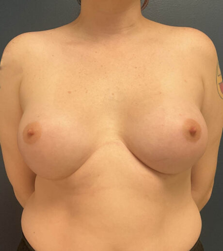 Breast Augmentation case #19568