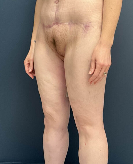 After Weight Loss case #19489