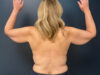 Arm Lift case #19456