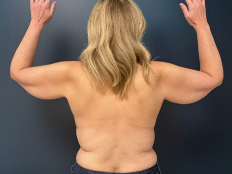Arm Lift case #19456