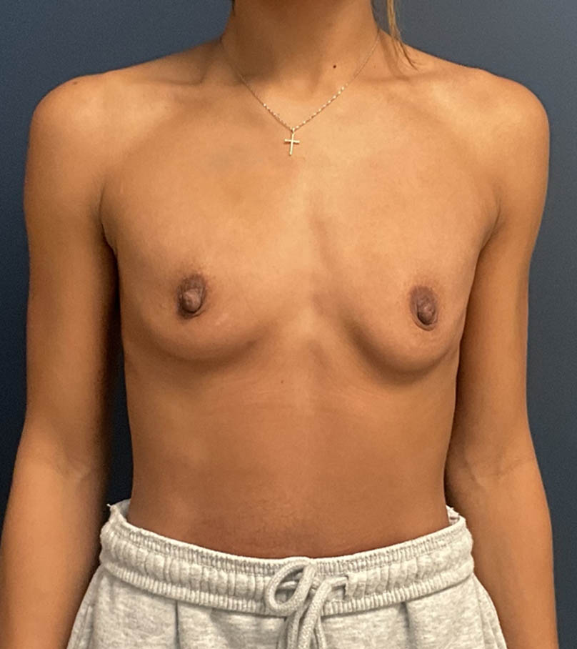 Breast Augmentation case #19573