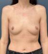 Breast Augmentation case #19689