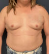 Breast Augmentation case #19696