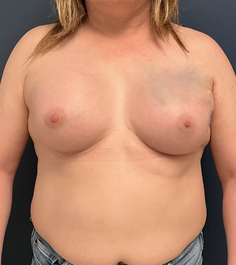 Breast Augmentation case #19696