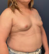 Breast Augmentation case #19696