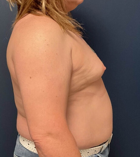 Breast Augmentation case #19696