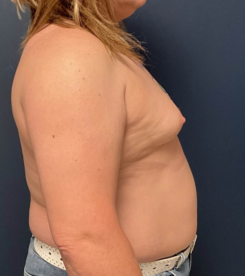 Breast Augmentation case #19696