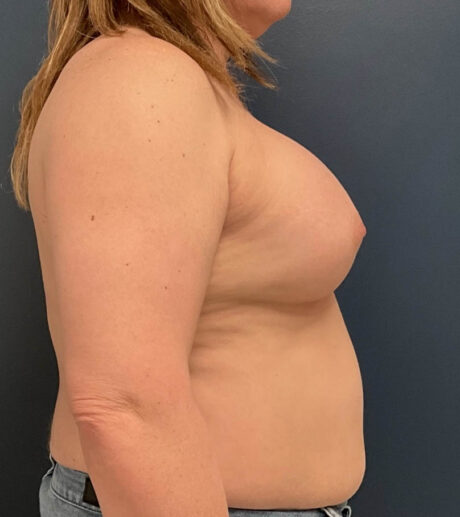 Breast Augmentation case #19696