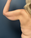 Arm Lift case #19456