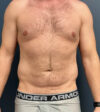 Liposuction case #20110