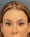 Brow lift case #20028